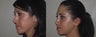 Facial Rejuvenation, non-surgical
