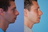 Chin Implant Augmentation