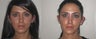 Facial Rejuvenation, non-surgical