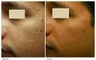 Acne Scarring Correction
