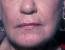 Chemical Peel