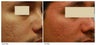 Acne Scarring Correction