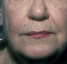 Chemical Peel