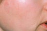 Chemical peel