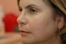 Hetter facial resurfacing