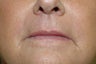 Hetter facial resurfacing