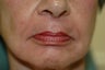 Hetter facial resurfacing