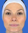 Chemical Peel