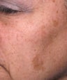 Melanage Peel to Treat Melasma and Hyperpigmentation