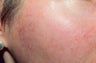 Chemical peel