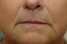 Hetter facial resurfacing