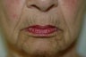 Hetter facial resurfacing
