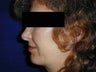 Chin Implant