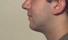 Chin implant
