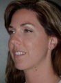 Chin Augmentation Surgery, Non-Surgical Under Eye Dermafillers