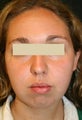 Liposuction face