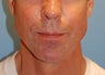 Jaw Augmentation with Implant