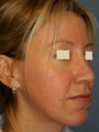 Rhinoplasty