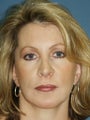 Chin Augmentation, Revision Rhinoplasty, and Facial Rejuvenation