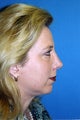 Chin Implant, Rhinoplasty