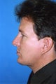 Chin Implant, Rhinoplasty