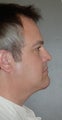 Chin Augementation