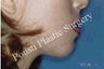 Chin Implants