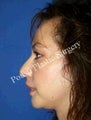 Chin Implants, Nose Surgery (Rhinoplasty)