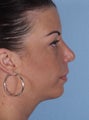 Balance Facial Features with A Chin Implant