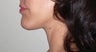 Chin Implant Procedure Combined with Facelift.