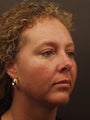 25 year old chin implant
