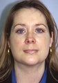 Before and After Chin Implant With Liposuction (Front View)
