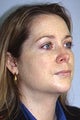 Before and After Chin Implant with Liposuction (Quarter View)