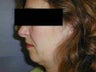 Chin Implant