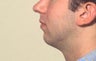 Chin implant