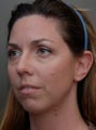 Chin Augmentation Surgery, Non-Surgical Under Eye Dermafillers