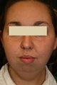 Liposuction face