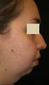 Liposuction face