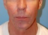Jaw Augmentation with Implant