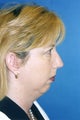 Chin Implant, Rhinoplasty
