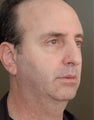 Chin Augementation