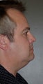 Chin Augementation