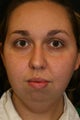 Liposuction and Chin Implant