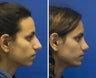 Chin Implantation with Rhinoplasty