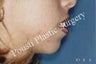 Chin Implants