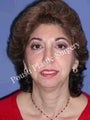 Chin Implants