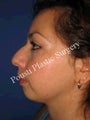 Chin Implants, Nose Surgery (Rhinoplasty)
