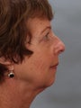 Chin Implant to correct profile view