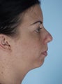 Balance Facial Features with A Chin Implant