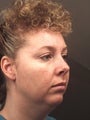 25 year old chin implant